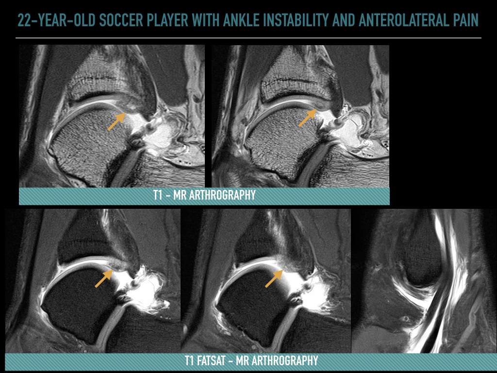 Figure 4 for case Syndesmotic ankle impingement